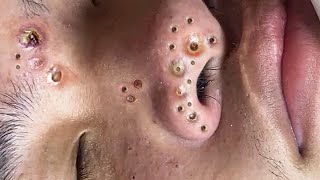 Big Cystic Acne Blackheads Extraction Blackheads amp Milia Whiteheads Removal Pimple Popping  1347 [upl. by Eiltan380]