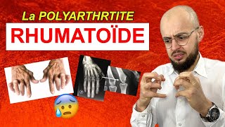 Les symptômes de la POLYARTHRITE RHUMATOÏDE [upl. by Rabbaj]