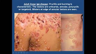 Lecture 49 Bullous Pemphigoid and related diseases PartII Rooks chapter 50 [upl. by Manvell]