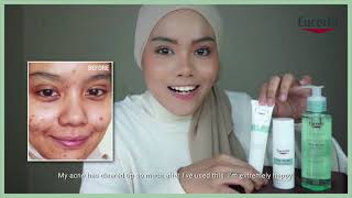 Clear Your Acne Effectively with Eucerin ProACNE Solution [upl. by Sherburne674]