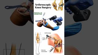 Arthroscopic Knee Surgery medical animation 3d short BiologywithAliya [upl. by Elacsap]