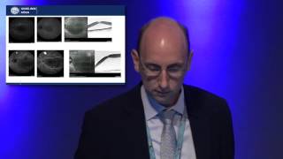 EuretinaESCRS 2016  Subthreshold Laser Therapy for Central Serous Chorioretinopathy [upl. by Akciret]