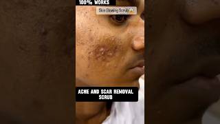 Acne and scars removal scrub😱 skincare skincareproducts shortvideo clearskin [upl. by Eliga]