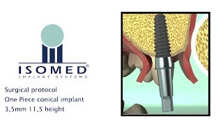 ISOMED  Surgical Protocol  One Piece conical implant [upl. by Elorac]