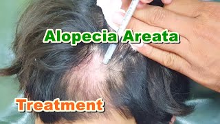 Alopecia Areata Treatment by ILS Intralesional Steroid Injections  Triamcinolone Acetonide [upl. by Frederic]