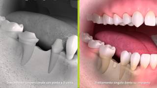 Straumann  Trattamento convenzionale con ponte a 3 unità e trattamento singolo dente su impianto [upl. by Caine]