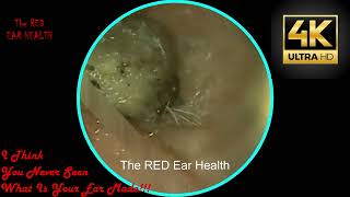 THE MAN  Liquid Ear Wax Removal [upl. by Remark]