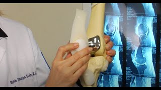 Surgery for Patellofemoral Arthritis by Dr Shubin Stein [upl. by Hermosa]