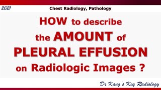 The Amount of Pleural Effusion on Radiologic Imaging [upl. by Cence]