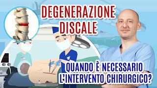 DEGENERAZIONE DISCALE Quando è necessario un intervento chirurgico Dott Federico Pecoraro [upl. by Anitnamaid]