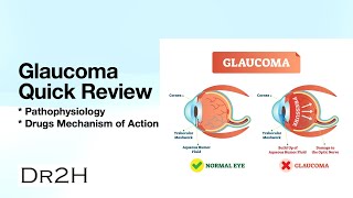 Glaucoma Quick Review  Explain Clearly [upl. by Emalee224]