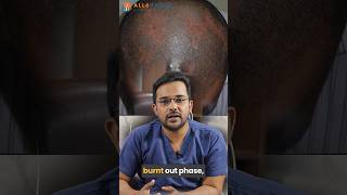 Diagnosis amp Treatment of Scarring Alopecia  Dr Alok Sahoo  alloroots [upl. by Refynnej979]