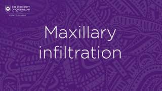 Dental local anaesthetics Maxillary infiltration [upl. by Marba]