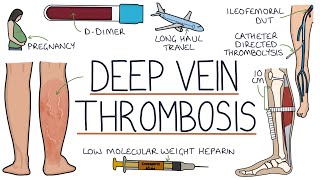 Understanding Deep Vein Thrombosis DVT [upl. by Deering716]