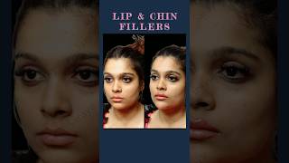 Transform Your Look with Lip and Chin Fillers Sarayu Clinics filler [upl. by Asil]