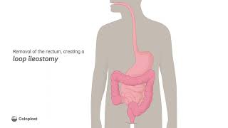 Creation of loop ileostomy by removing the rectum  Ostomy surgery  Coloplast India [upl. by Kentigerma]