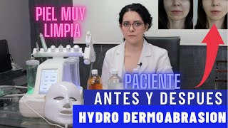 Como Hacer Hydro Dermoabrasion y Resultados Antes y Después [upl. by Garlen266]