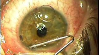 IntraLase Lasik Surgery  Right Eye [upl. by Atihana]