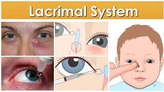 Lacrimal system 4Last Major Topic Dry Eye Syndrome Keratoconjunctivitis Sicca [upl. by Einnim]