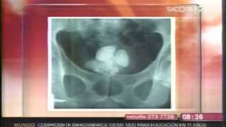 Litiasis Renal síntomas consecuencias y prevención [upl. by Clercq178]