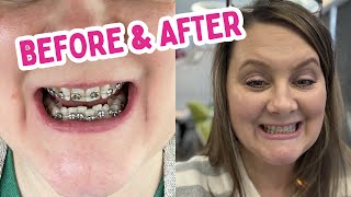 Mom Gets Braces Off  Before and After  Clear Retainers  Crystal Lopez [upl. by Eserrehs938]