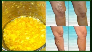 HOW TO GET RID OF VARICOSE VEINS FAST  NATURAL REMEDY FOR VARICOSE VEINS Khichi Beauty [upl. by Adnaloj]