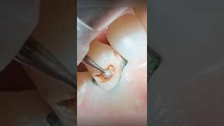 How To Fix Cavities In Front Teeth [upl. by Ravilob]