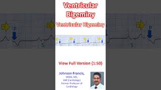 Ventricular Bigeminy [upl. by Rab]