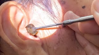 Elderly Mans Earwax Finally Removed [upl. by Dee]