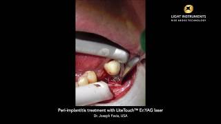 Peri implantitis treatment with LiteTouch™ ErYAG laser [upl. by Kucik]