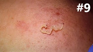 BLACKHEADS EXTRACTIONS on Happy   9 [upl. by Girovard]