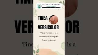 Top 5 Home Remedies for Tinea Versicolor shorts [upl. by Goober]