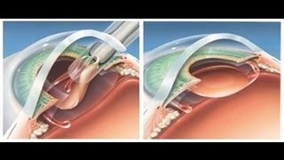 Cataract Surgery Animation [upl. by Pompea899]