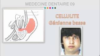 Cellulite dorigine dentaire part 2  localisation topographique [upl. by Lynd]