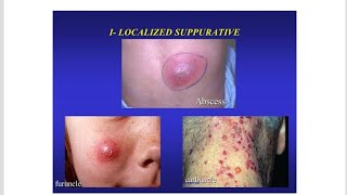 Suppurative  Purulent Inflammation  Definition and Characteristics [upl. by Alywt]