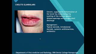 Salivary gland imaging  DrKVSwathi Lecturer Oral Medicine and Radiology [upl. by Eramal]