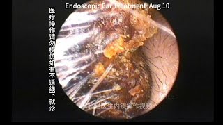 Removal of severely blocked earwax embolism [upl. by Whitney595]