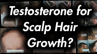 Testosterone Doesnt Grow Hair on the scalp [upl. by Annim]