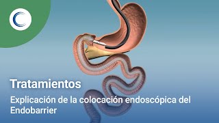 Explicación de la colocación endoscópica del Endobarrier [upl. by Raama243]