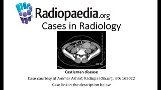 Castleman disease Radiopaediaorg Cases in Radiology [upl. by Arahset]