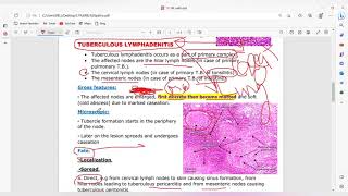 Non neoplastic lymhoma [upl. by Virnelli]