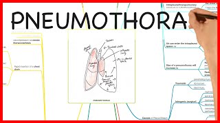 PNEUMOTHORAX  PHYSIOLOGY SERIES [upl. by Atsillac]