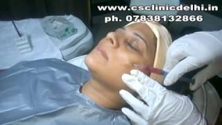 TREATMENT OF MELASMA WITH PRPPlatelet Rich Plasma DR CHETNA SINGH [upl. by Sarajane]