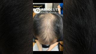 Unbelievable Transformation Diffuse Thinning Dr Ratchathorn [upl. by Meesan]