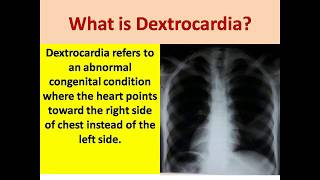 What is Dextrocardia  Dextrocadia Facts [upl. by Leschen823]