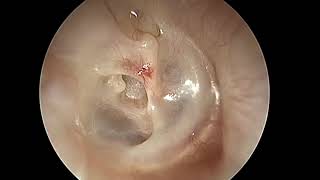 Endoscopic tympanoplasty with ossiculoplasty [upl. by Arev264]