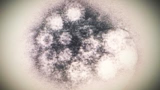 Mysterious Virus May Include Paralysis [upl. by Standford]