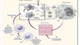 Managing Single Organ SLEITP [upl. by Olonam]