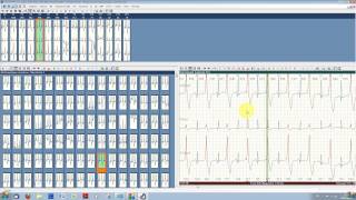 Typcial ECG analysis with ECGpro Holter 743 [upl. by Acirretal]