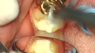 37 Full Zirconia Crown prep [upl. by Eneleahs]